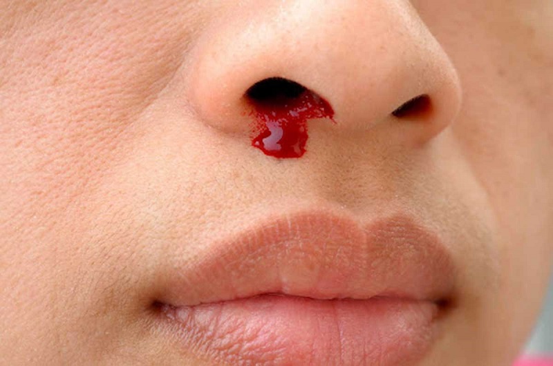 Giảm tiểu cầu có phải là ung thư máu không? Những điều cần lưu ý